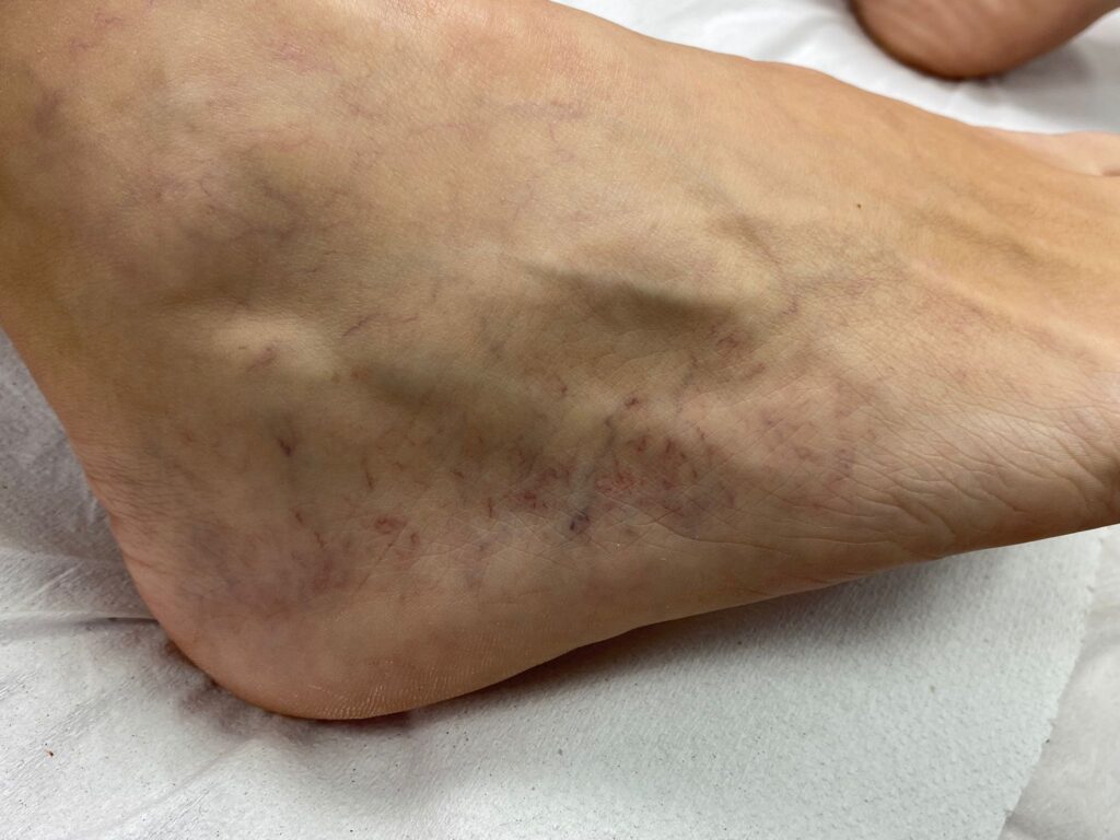 arañas vasculares zaragoza quitar rapido