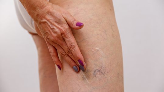 eliminar arañas vasculares